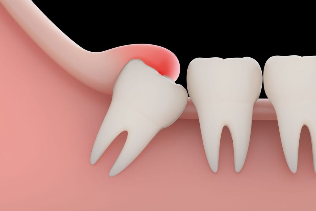 A Guide to Avoid Dry Socket after Wisdom Teeth Removal - Wisdom Dental  Emergency