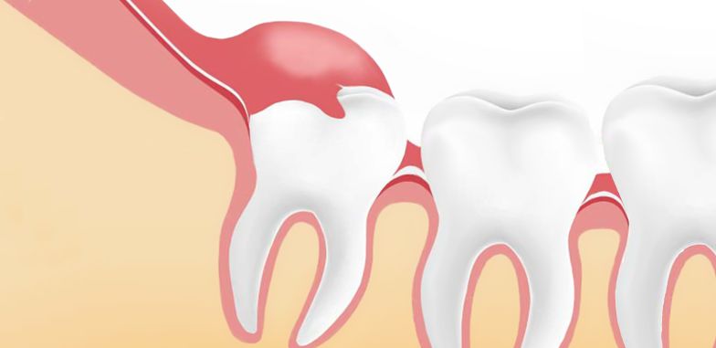 How Wisdom Teeth Are Removed Things To Know Before You Get This