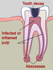 Dental Emergency Tooth Extraction