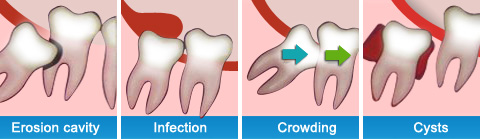 Wisdom Teeth Removal at Wisdom Dental Emergency Melbourne