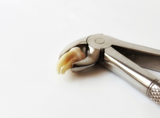 Why should Wisdom Teeth be removed? Why should Wisdom Teeth be removed?