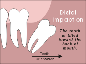 wisdom tooth distal impaction