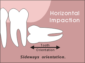 wisdom tooth horizontal impaction
