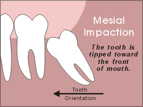 wisdom tooth mesial impaction