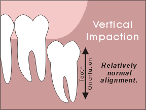 wisdom tooth vertical impaction